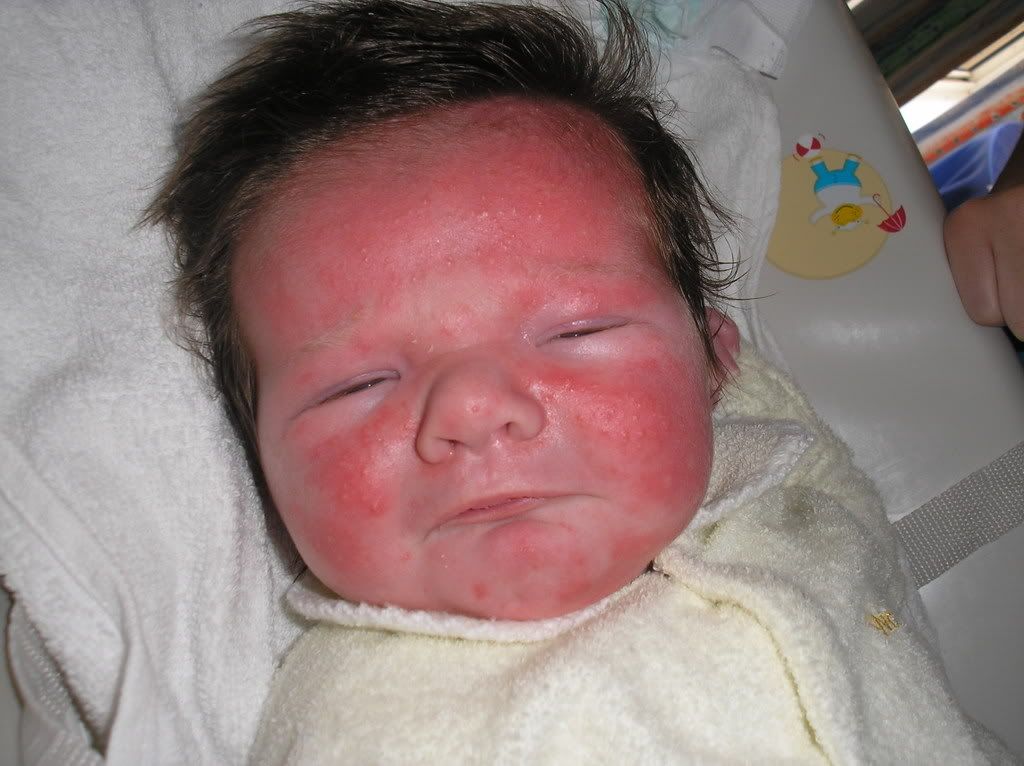 yeast-infection-newborn-face-guide