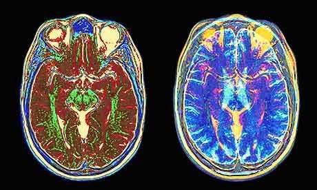 brain top Pictures, Images and Photos