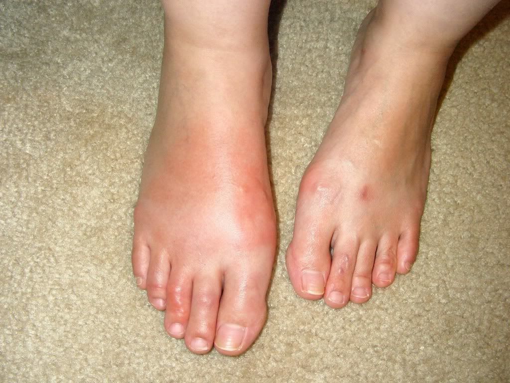 Painful Swollen Foot Photo by ashleysueallen Photobucket