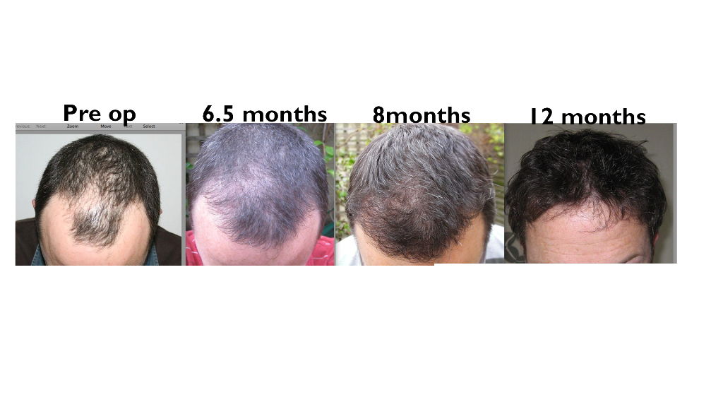 Growth times + Patience - Forum By and for Hair Loss Patients